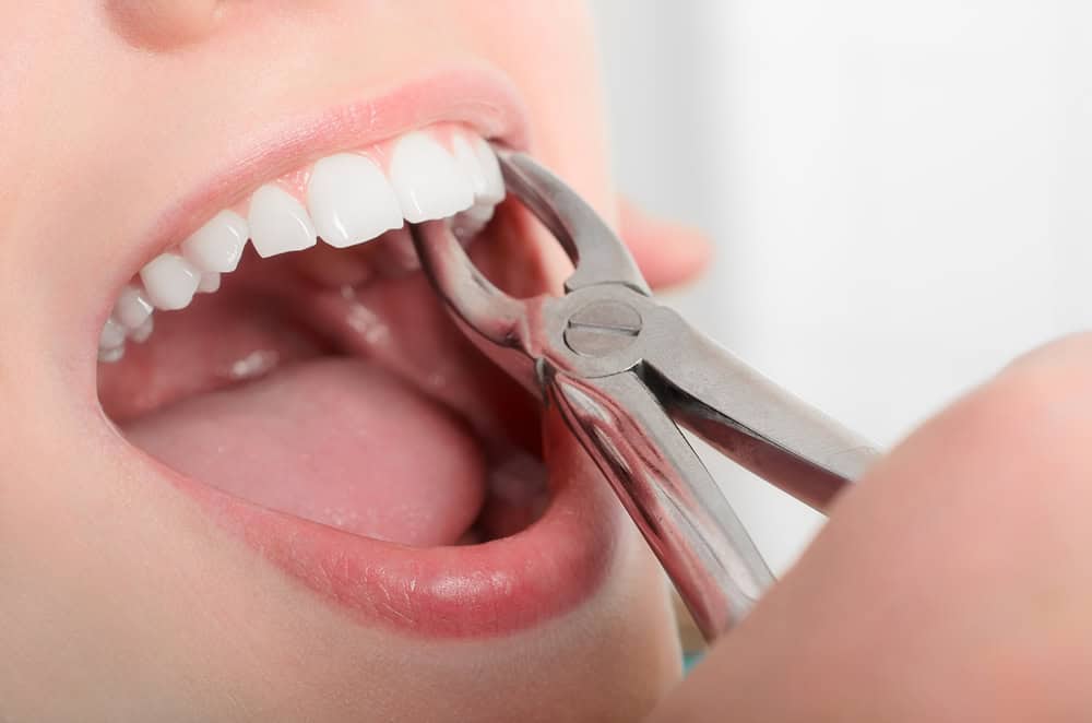 Dental Extractions